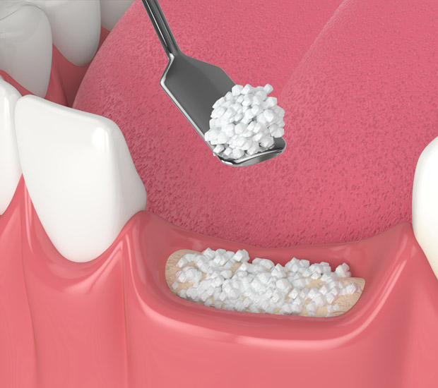 Elk Grove Will I Need a Bone Graft for Dental Implants