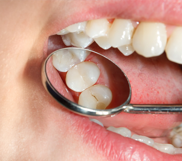 Elk Grove Dental Sealants