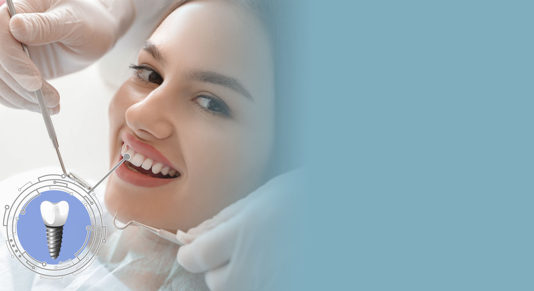 Dental Implants with Abutments and Crowns